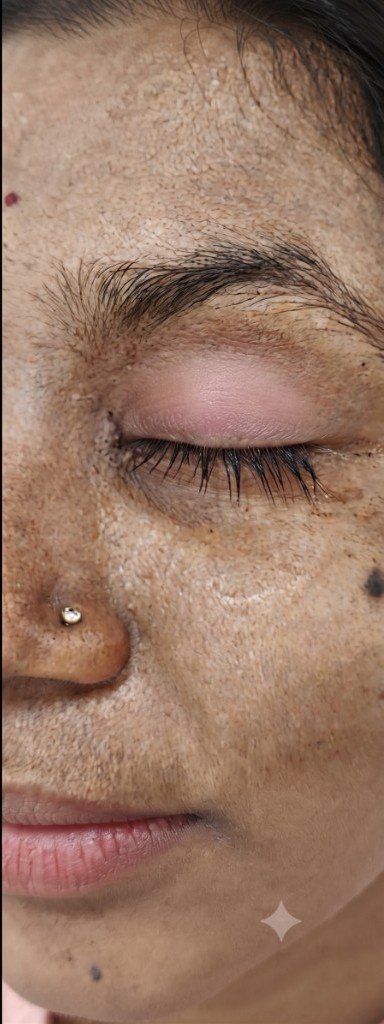 Eyelid after lesion care at Prohealth Care Clinic