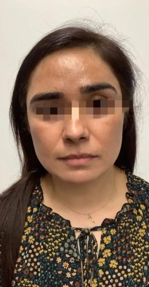 Facial pigmentation after treatment at Prohealth Care Clinic