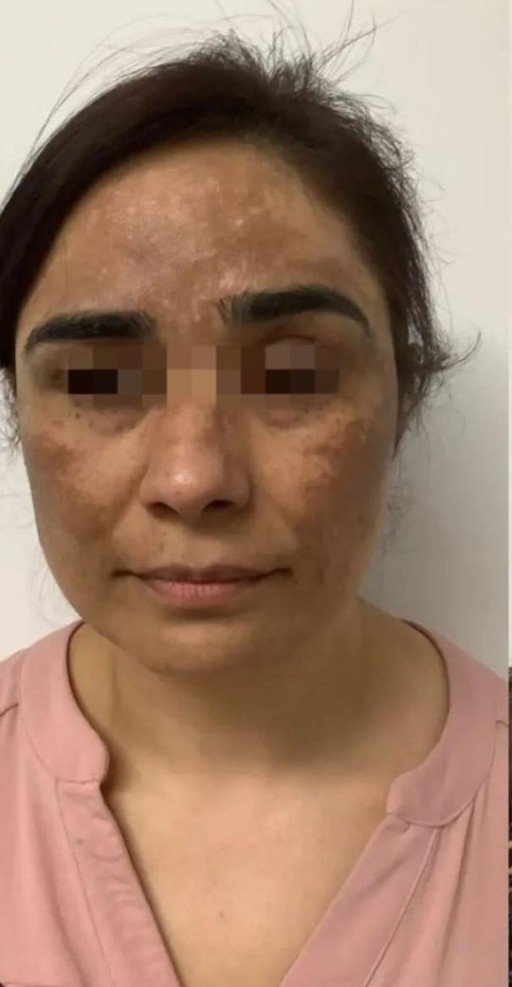 Facial pigmentation before treatment at Prohealth Care Clinic