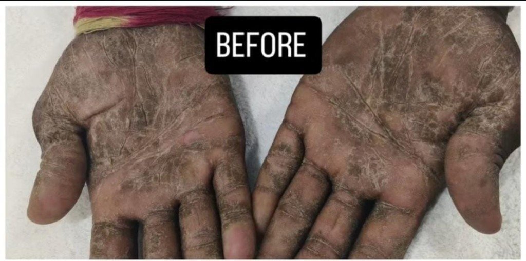 Palms before dermatology treatment at Prohealth Care Clinic