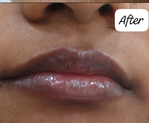 Lips after pigmentation treatment at Prohealth Care Clinic