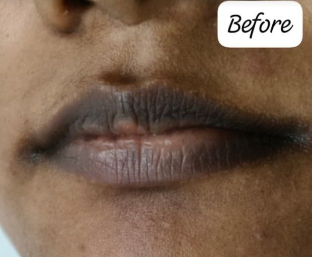 Lips before pigmentation treatment at Prohealth Care Clinic