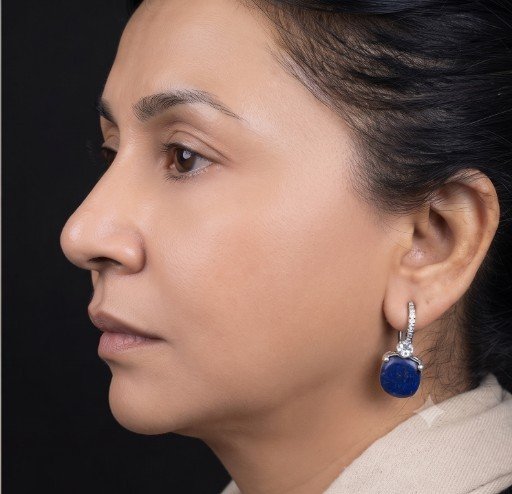 Facial profile after pigmentation care at Prohealth Care Clinic