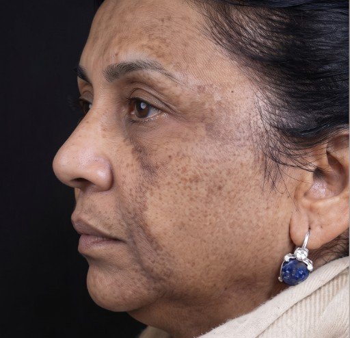Facial profile pigmentation before treatment at Prohealth Care Clinic